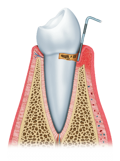 gum disease graphic stage 1