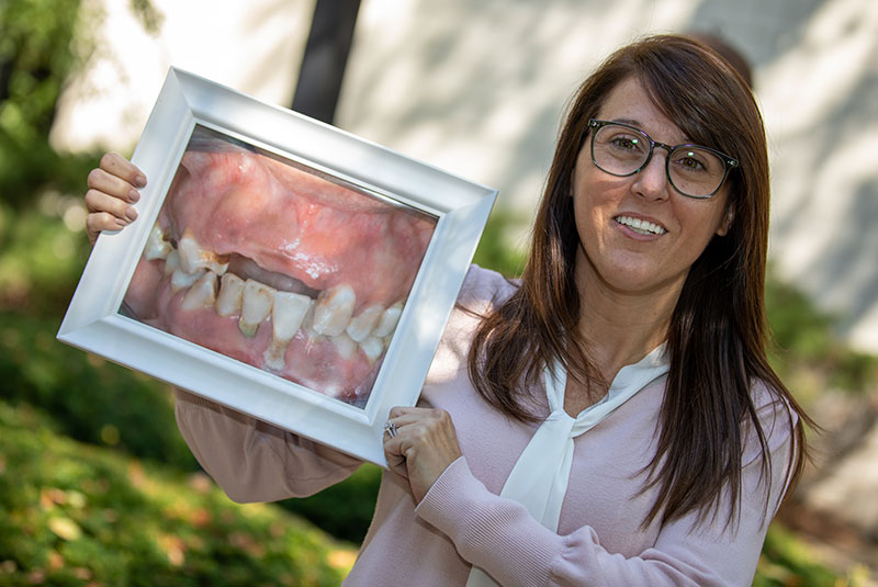 before and after full mouth dental implants