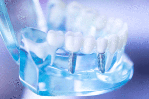 Dentist clear jaw model, dental tooth implant.